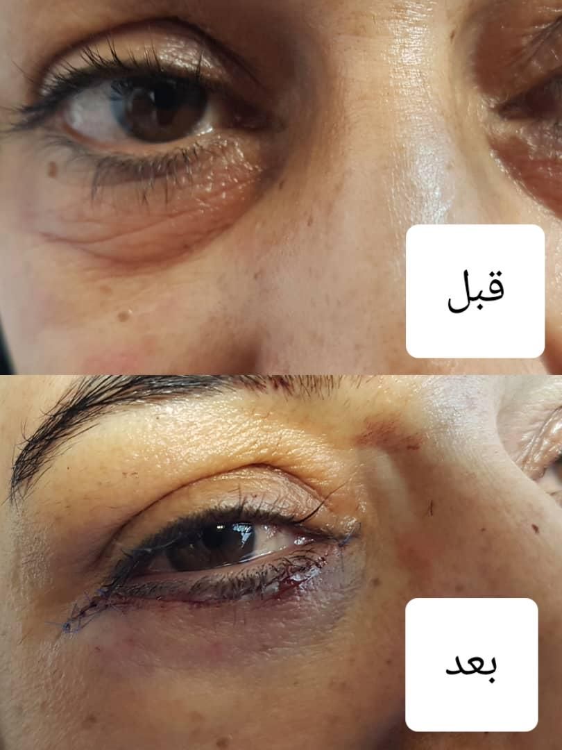رفع چروک زیر چشم/رفع پف زیر چشم|خدمات آرایشگری و زیبایی|اصفهان, خلجا|دیوار