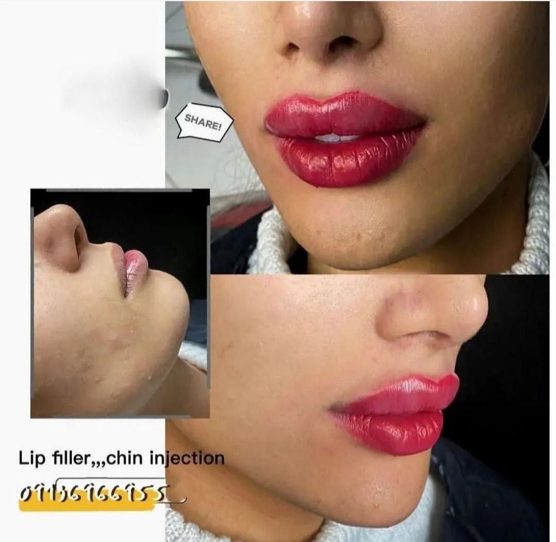 جشنواره تزریق ژل و بوتاکس و آموزش|خدمات آرایشگری و زیبایی|اصفهان, بهار آزادی|دیوار