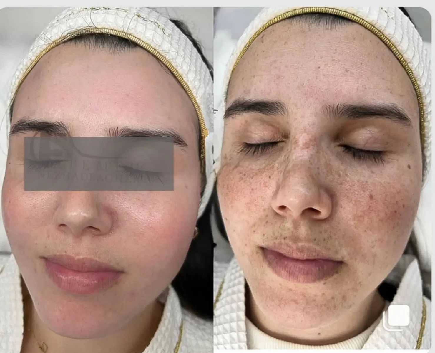 جشنواره درمان تضمینی کک و مک/ زگیل / فقط در 1 جلسه|خدمات آرایشگری و زیبایی|اصفهان, باتون|دیوار