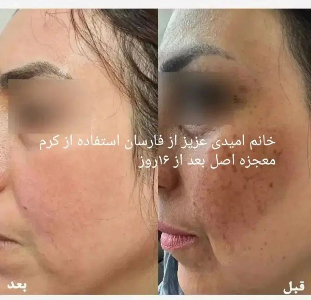 با این کرم فقط با ده روز پوستت رو فوق العاده کن|آرایشی، بهداشتی، درمانی|لردگان, |دیوار