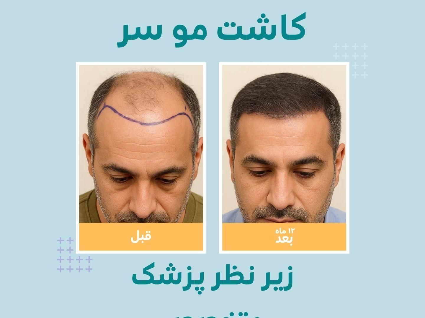 پیوند/ مو ابرو / روش DHI / با خط رویش پنهان|خدمات آرایشگری و زیبایی|تهران, دروس|دیوار