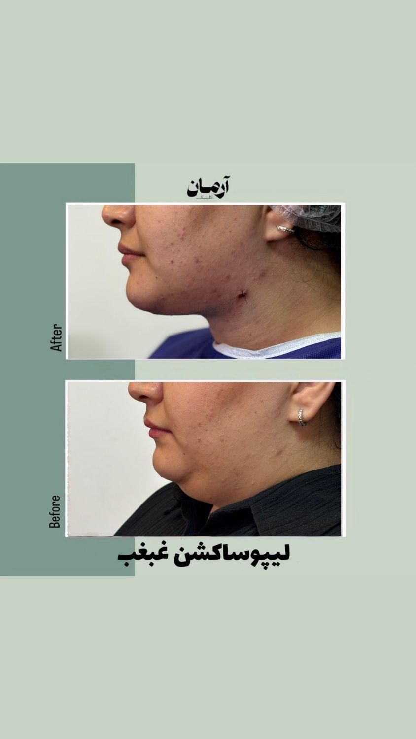 لیپو ساکشن غبغب و بوکال فت ( + شرایط )|خدمات آرایشگری و زیبایی|مشهد, گلبرگ شمالی|دیوار
