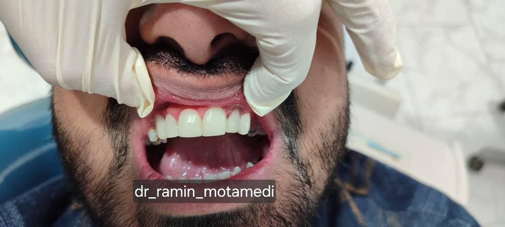 ایمپلنت/کامپوزیت/دندانپزشکی/اقساط|خدمات آرایشگری و زیبایی|شیرگاه, |دیوار