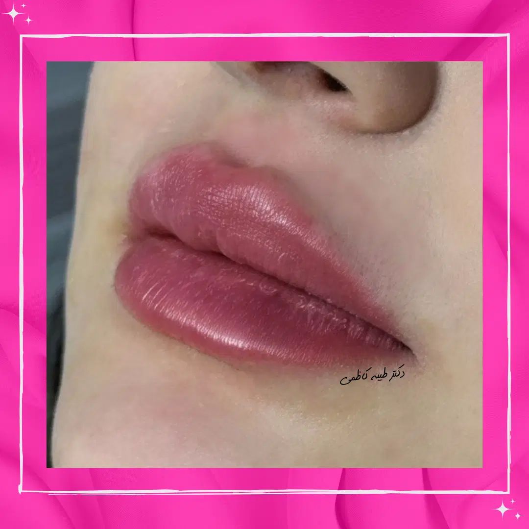 تخفیفات 50% دکتر کاظمی، بوتاکس فیلر مزو ژل لب روسی|خدمات آرایشگری و زیبایی|مشهد, احمدآباد|دیوار