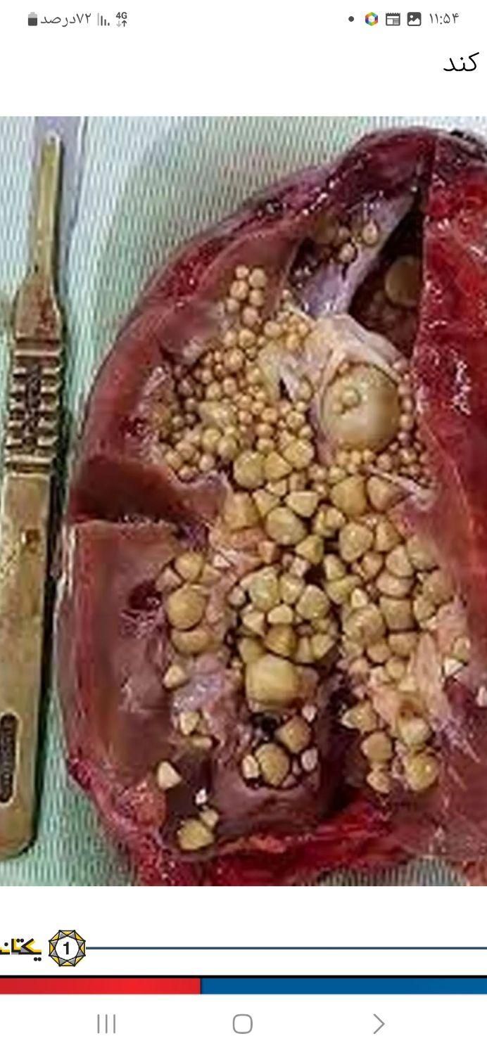 درمان سنگ کلیه دفع مجاری ادراری دریک روزبدون جراحی|خدمات آرایشگری و زیبایی|شیراز, گود عربان|دیوار
