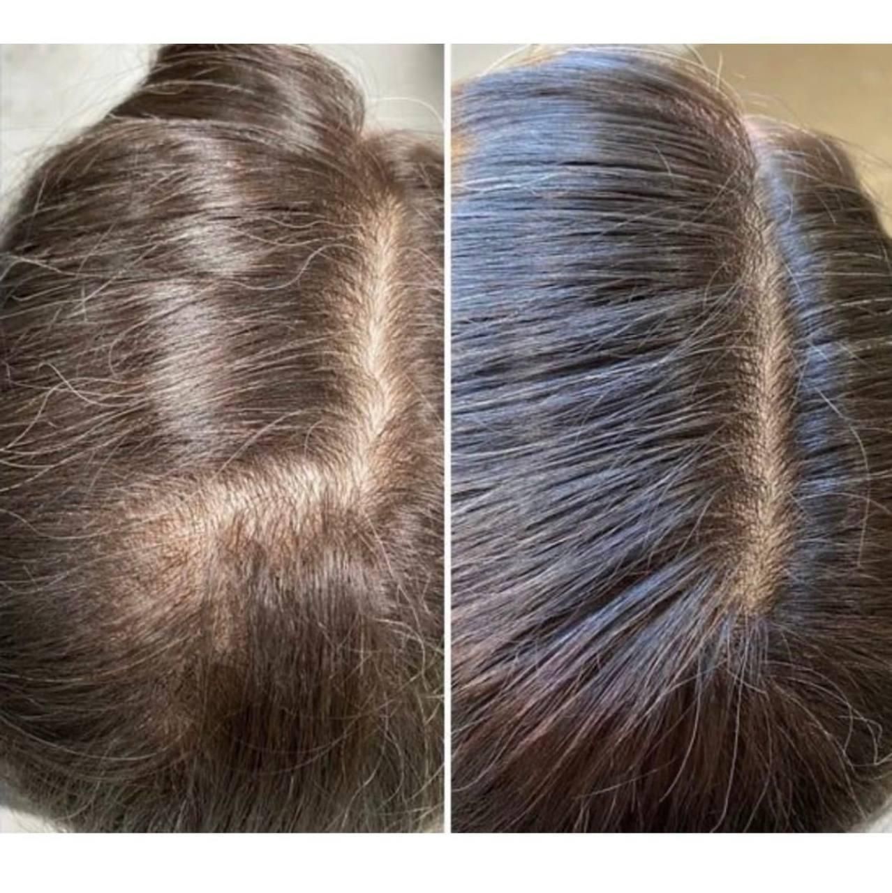 آفر20 درصد درمان قطعی ریزش مو و رویش بدون بازگشت|خدمات آرایشگری و زیبایی|مشهد, کوثر|دیوار