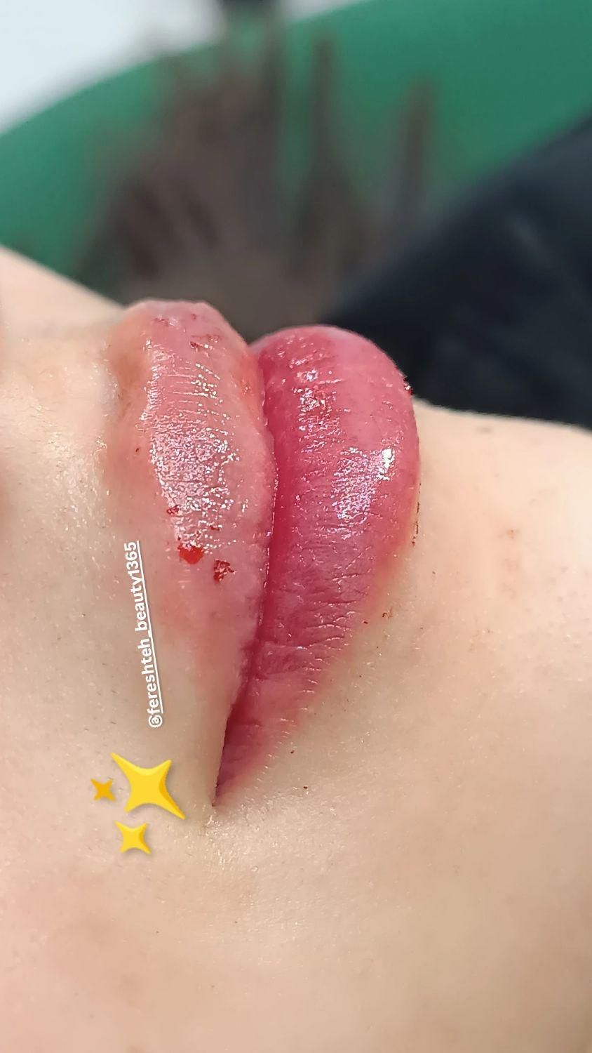 خدمات تزریق فیلر صورت بوتاکس مزوتراپی ولیزر|خدمات آرایشگری و زیبایی|نسیم‌شهر, |دیوار