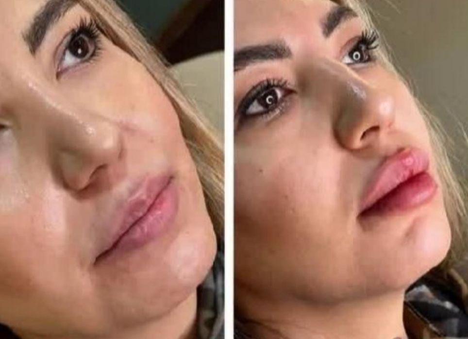 تزریق ژل و بوتاکس فقط ۵۰۰هزارتومان|خدمات آرایشگری و زیبایی|فولادشهر, B2|دیوار