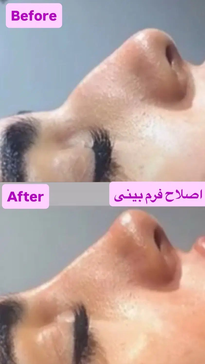 تزریق ژل وبوتاکس تخفیف ویژه|خدمات آرایشگری و زیبایی|تهران, خانی آباد نو شمالی|دیوار