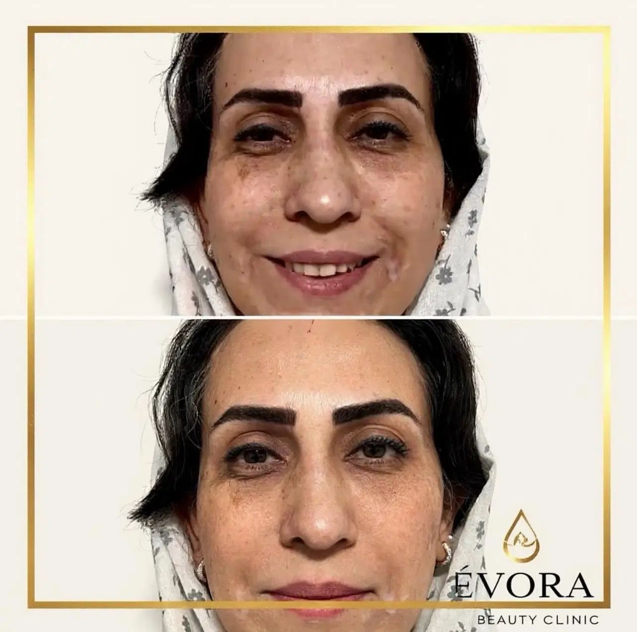 بوتاکس و فیلر اصل با تخفیف ویژه، زیرنظر پزشک|خدمات آرایشگری و زیبایی|ساری, |دیوار