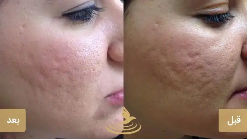 از بین بردن جای جوش و لک ،به روش مزونیدلینگ|خدمات آرایشگری و زیبایی|شیراز, معالی‌آباد|دیوار