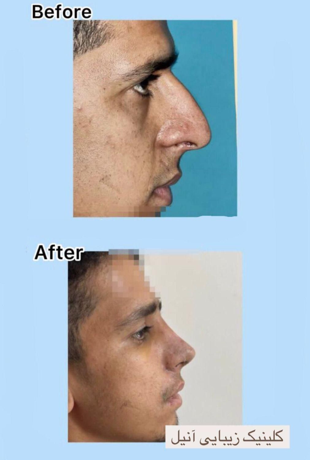 جراحی بینی با تخفیف استثنایی به مدت ۱۰روز|خدمات آرایشگری و زیبایی|بندرعباس, |دیوار