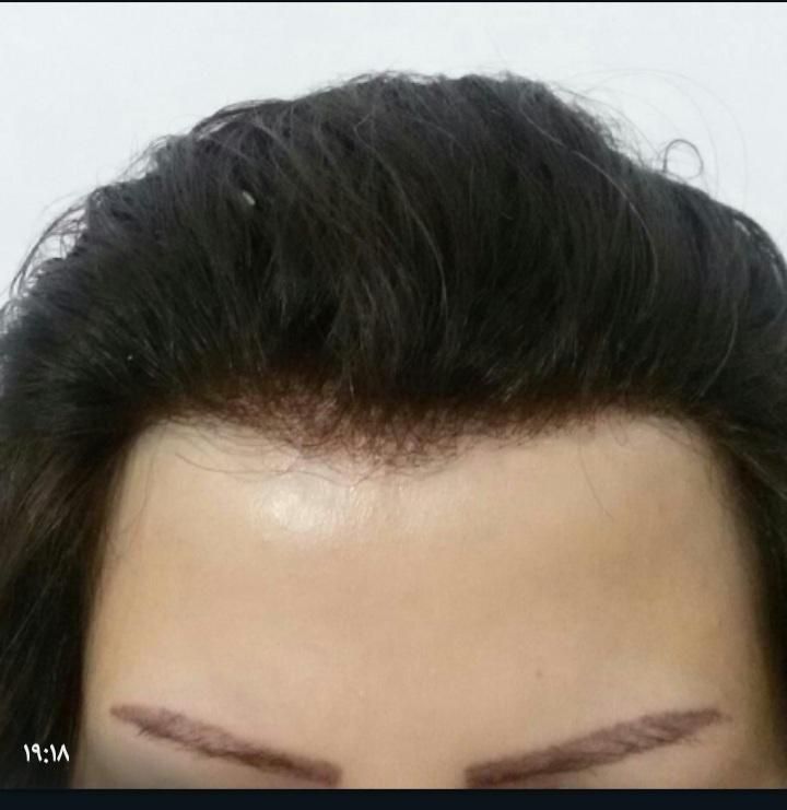 پروتز مو و ترمیم موی شقایق. چسب پروتز|خدمات آرایشگری و زیبایی|تبریز, |دیوار