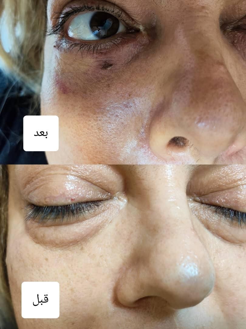 رفع چروک زیر چشم/رفع پف زیر چشم|خدمات آرایشگری و زیبایی|اصفهان, خلجا|دیوار