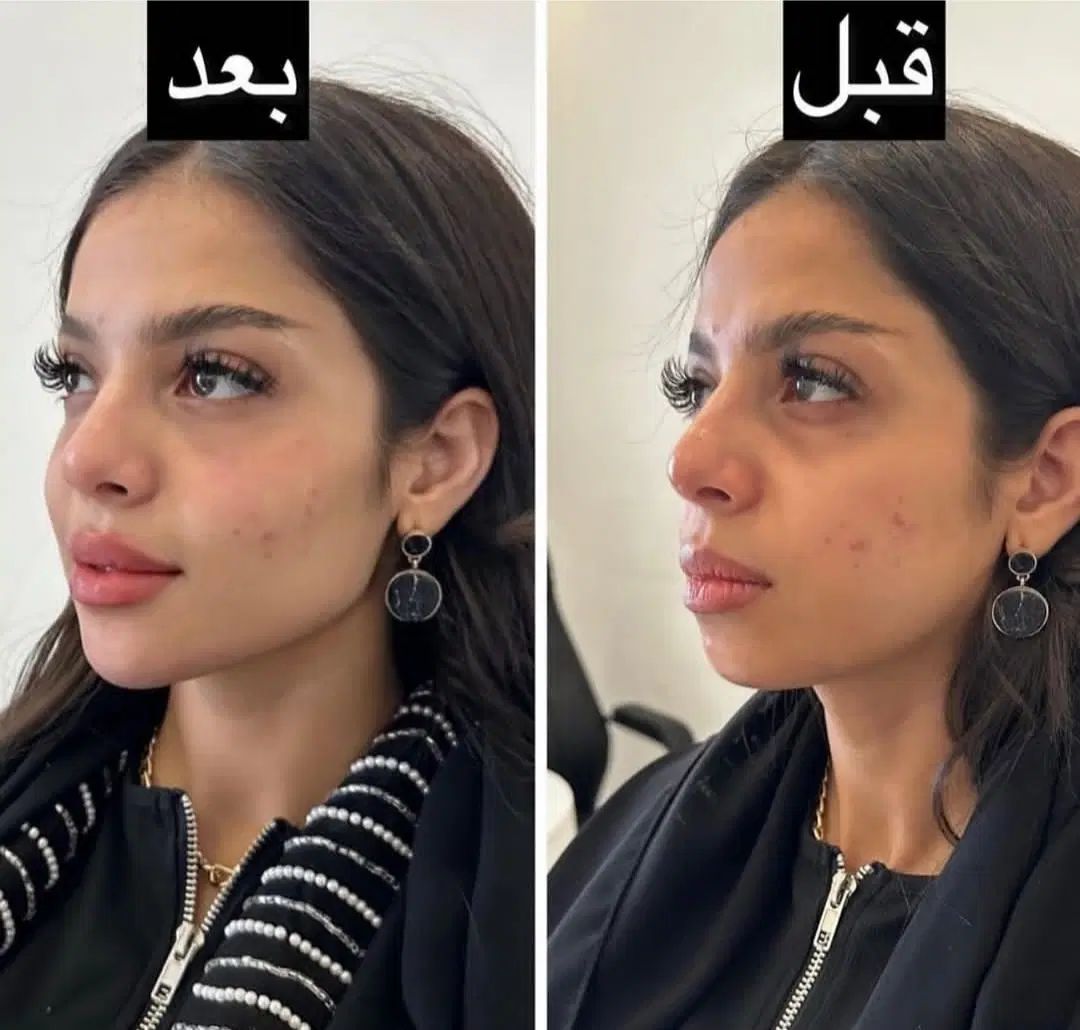 ژل و بوتاکس و پیرسینگ|خدمات آرایشگری و زیبایی|مشهد, خواجه ربیع|دیوار