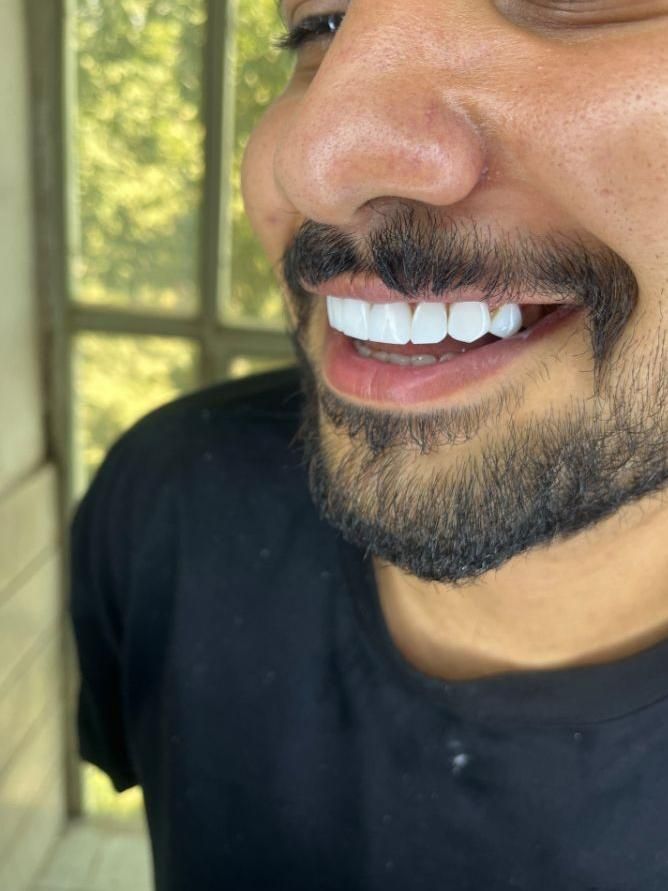 کامپوزیت دندان.تخفیف.ویژه|خدمات آرایشگری و زیبایی|بروجرد, |دیوار