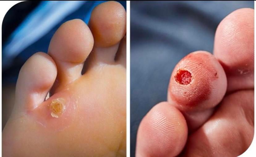 خالبرداری ،رفع کک ومک ،برداشتن میخچه توسط پزشک|خدمات آرایشگری و زیبایی|کرج, شهرک یاس جنوبی|دیوار