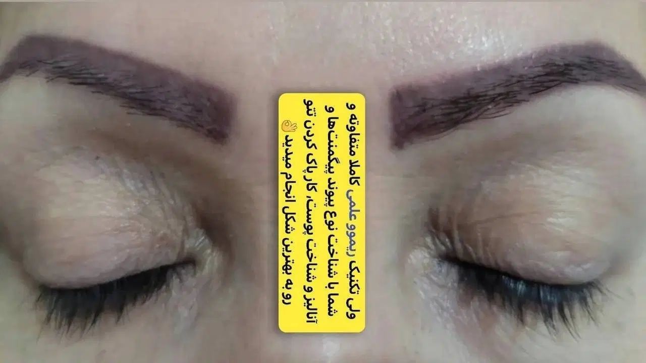 ریمووحذف تاتوومیکروبلیدینگ بدون لیزر+آموزش بامدرک|خدمات آرایشگری و زیبایی|تهران, جی|دیوار