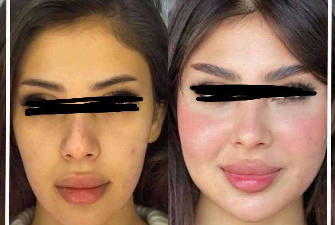 تخفیف فیلر صورت|خدمات آرایشگری و زیبایی|اهواز, زیتون کارمندی|دیوار