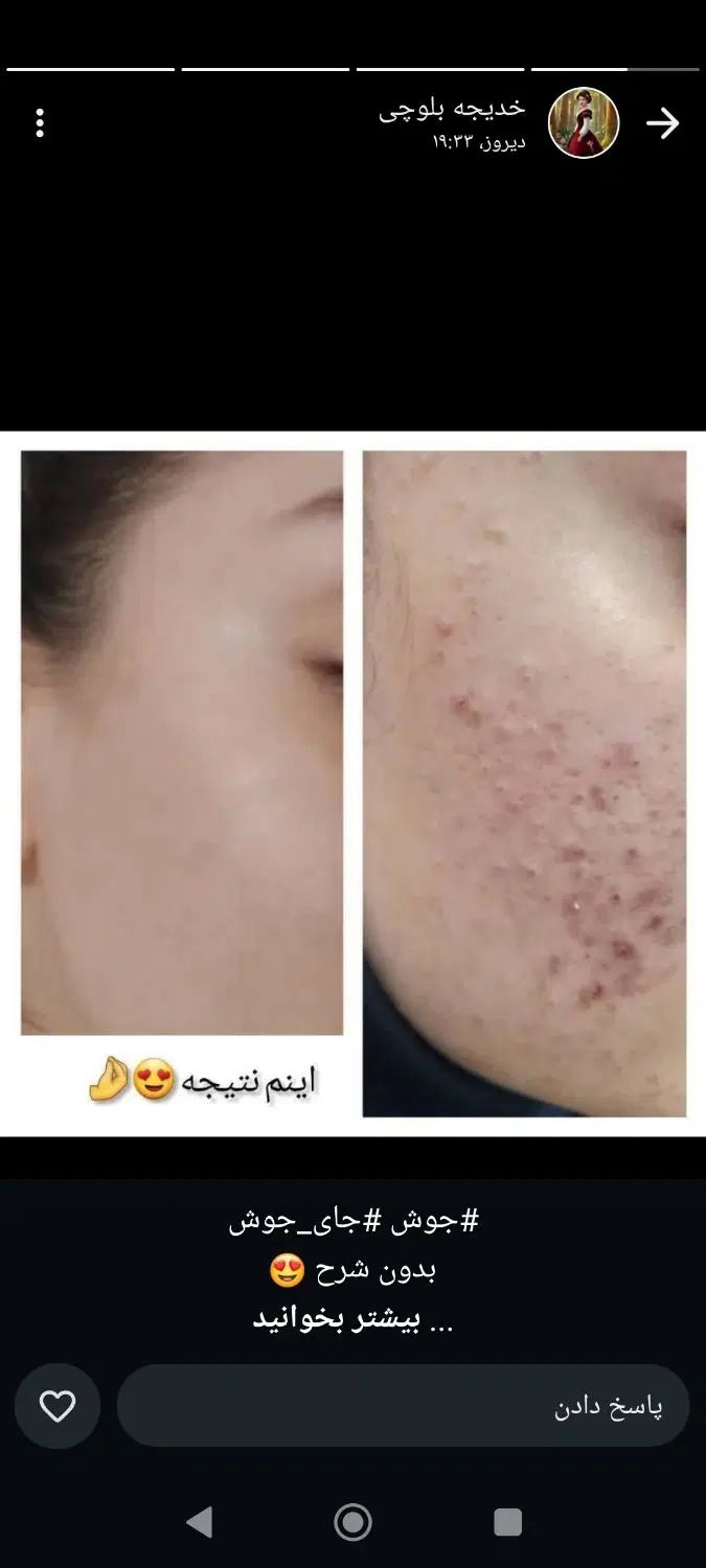 درمان تخصصی جوش های صورت|آرایشی، بهداشتی، درمانی|کرج, شهرک آسمان|دیوار