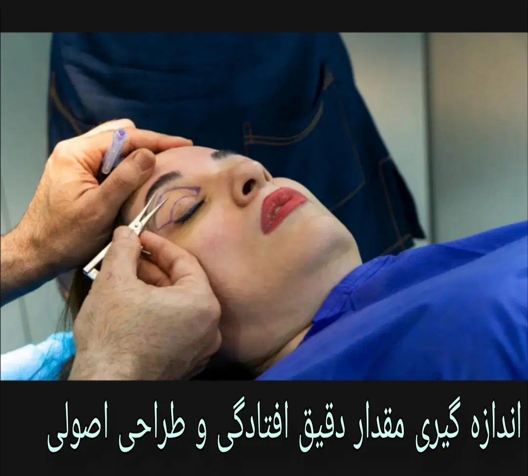 جراحی بلفاروپلاستی(رفع افتادگی پلک)بوکال فت/ساکشن|خدمات آرایشگری و زیبایی|تهران, هفت حوض|دیوار