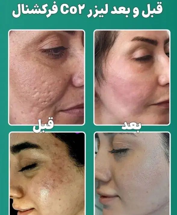 جلسه اول لیزر موهای زائد با کربن تراپی رایگان|خدمات آرایشگری و زیبایی|نجف‌آباد, شریعتی|دیوار