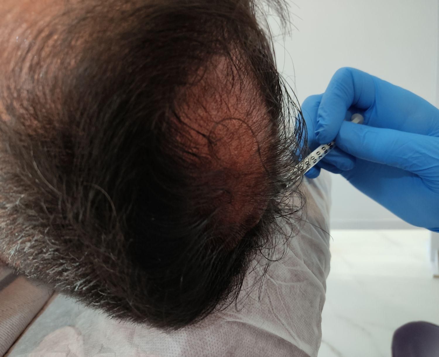 خدمات زیبایی بوتاکس ، ژل ،مزوتراپی، ریمو تتو هایفو|خدمات آرایشگری و زیبایی|فولادشهر, B2|دیوار