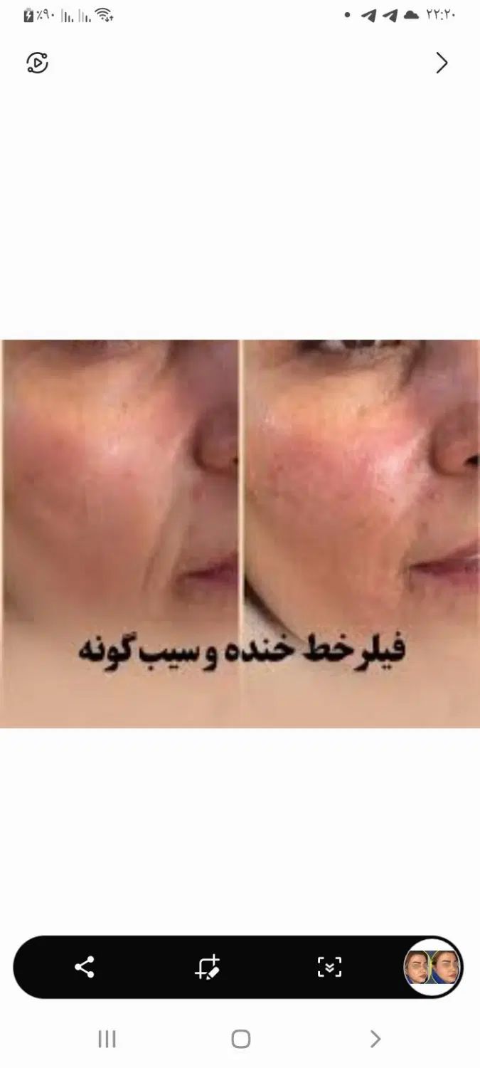 جشنواره تززیق فیلر،ژل وبوتاکس درهفده شهریور|خدمات آرایشگری و زیبایی|تبریز, |دیوار
