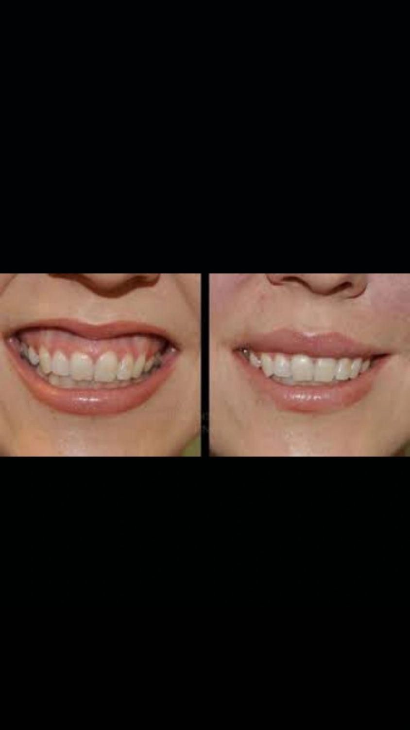 بوتاکس فقط ۹۵۰ ( پیشانی لبخند لثه ای زیر بغل و..)|خدمات آرایشگری و زیبایی|محمدیه-قزوین, |دیوار