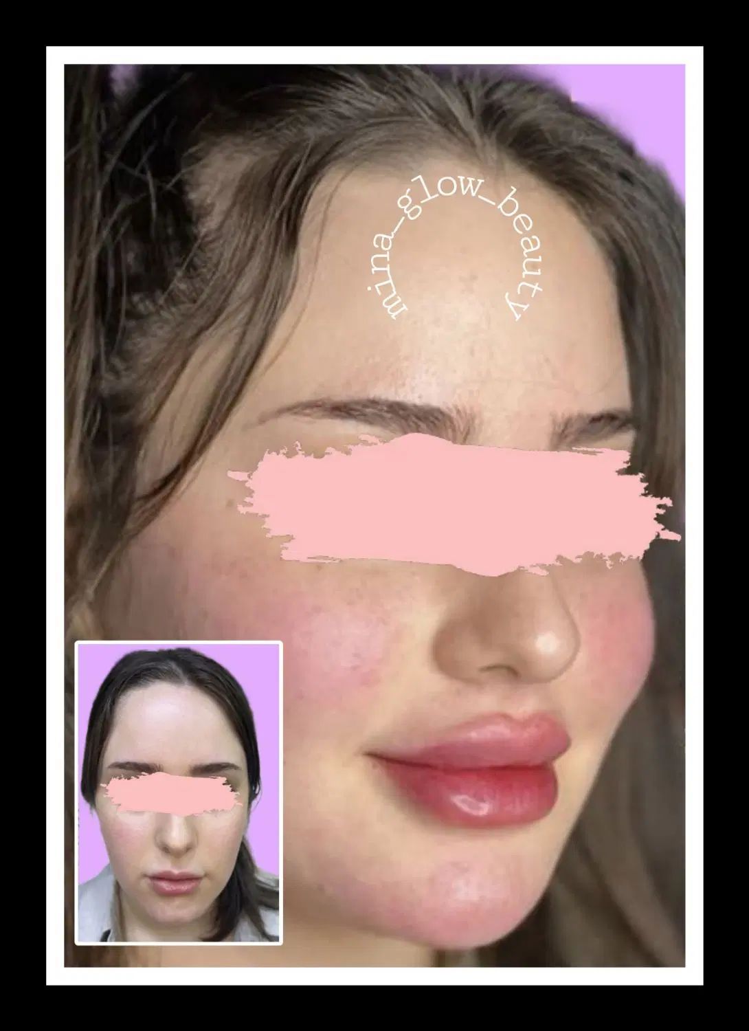 آموزش  و ارائه  ژل و بوتاکس و مزو|خدمات آموزشی|شیراز, سینما سعدی|دیوار