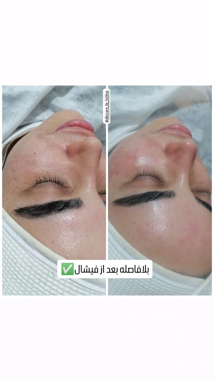 خدمات تخصصی پاکسازی فیشال صورت و بدن با دستگاه|خدمات آرایشگری و زیبایی|شاهین‌شهر, عطار|دیوار