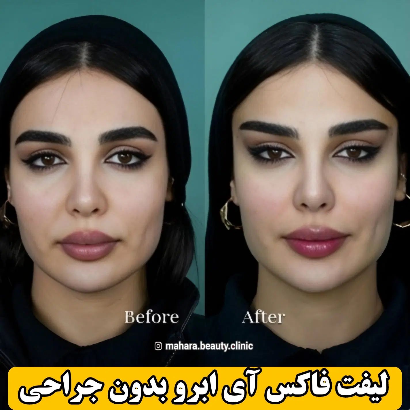 آف پکیج تخصصی FOX EYE پزشک پوست مو بینی زیبایی|خدمات آرایشگری و زیبایی|مشهد, هنرستان|دیوار