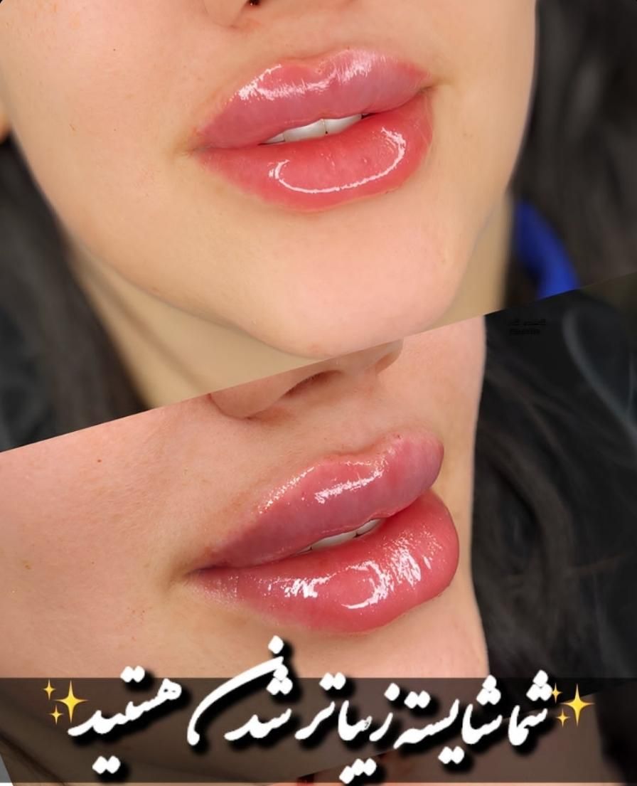 تزریق واموزش ژل بوتاکس مزوتراپی لیفت نخ...|خدمات آرایشگری و زیبایی|کرمانشاه, |دیوار