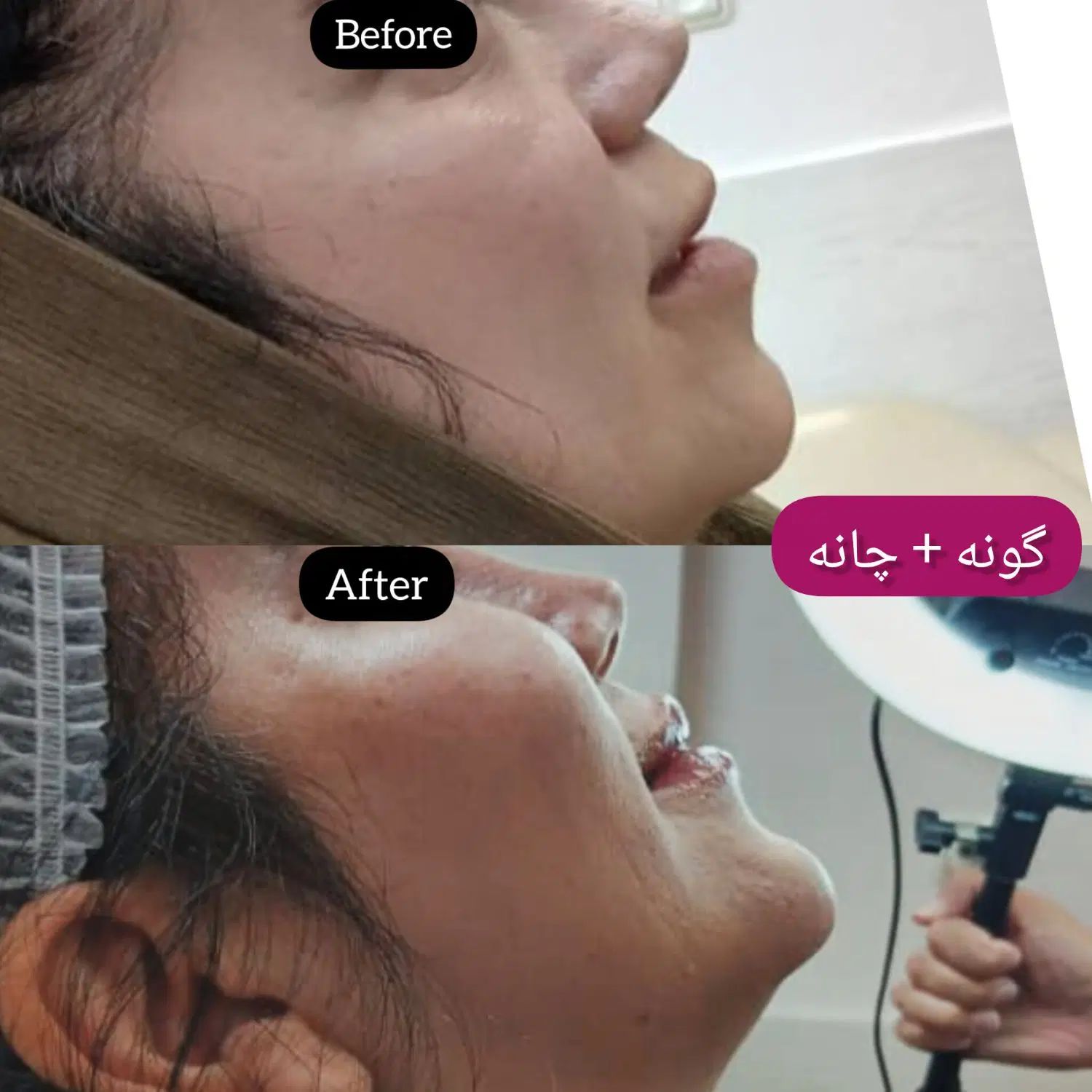 جشنواره بوتاکس/فیلر/مزوتراپی/پی آر پی  توسط پزشک|خدمات آرایشگری و زیبایی|زنجان, |دیوار
