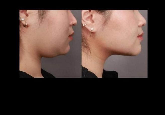 ژل بوتاکس ساکشن غبغب پی ار پی هایفو لیزر لاغری|خدمات آرایشگری و زیبایی|تبریز, |دیوار