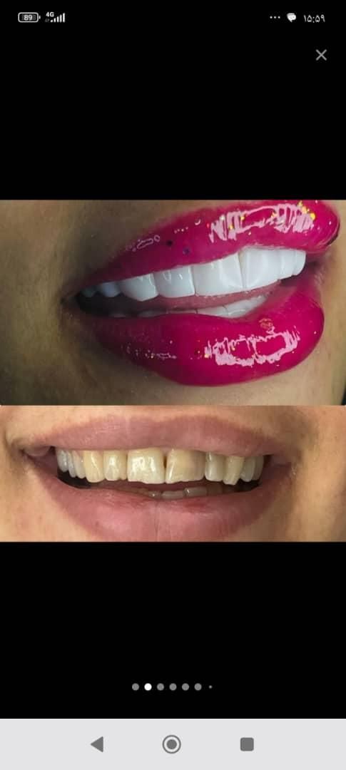 دندانپزشکی عصب کشی ،روکش،ایمپلنت،کامپوزیت|خدمات آرایشگری و زیبایی|بروجرد, |دیوار