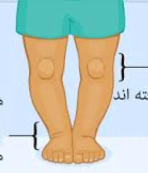 مرکز ارتوپدی اصلاح غیرجراحی انحرافات زانو|خدمات آرایشگری و زیبایی|همدان, |دیوار
