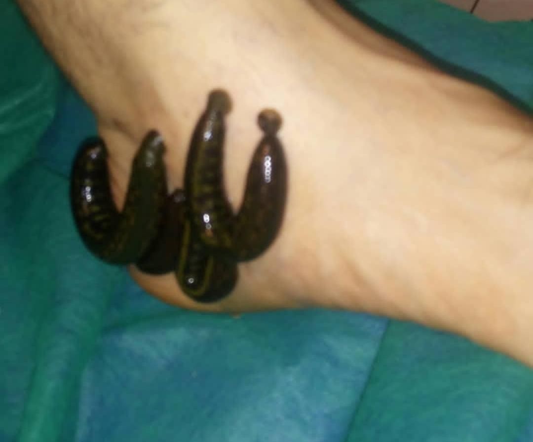 حجامت.زالودرمانی.فصدخون|خدمات آرایشگری و زیبایی|اسلامشهر, شهرک مهدیه|دیوار