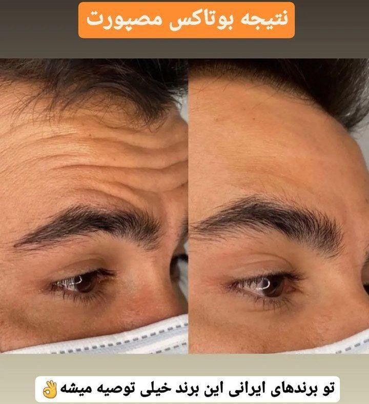 بوتاکس ژل آنزیم نخ لاغری بوتاکس 650 ژل اودری 450|خدمات آرایشگری و زیبایی|قم, باغ شازده|دیوار