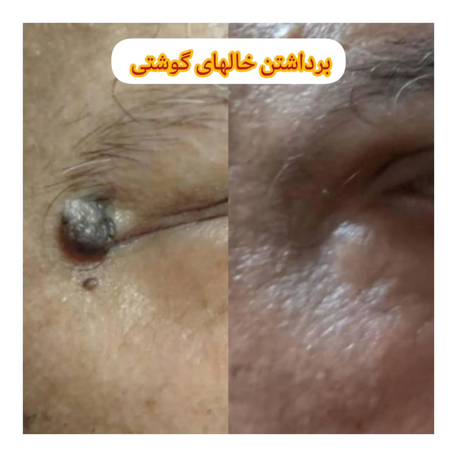 برداشتن خالهای گوشتی و سطحی|خدمات آرایشگری و زیبایی|کرج, عظیمیه|دیوار