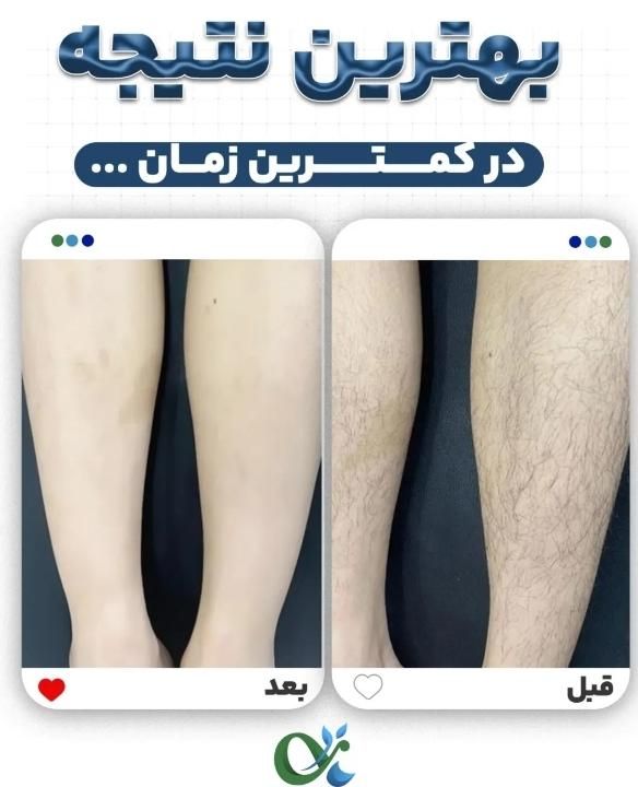 لیزر موج کندلا لیزر بانوان  لیزر آقایان لیزر خانم|خدمات آرایشگری و زیبایی|اصفهان, باغ زرشک|دیوار