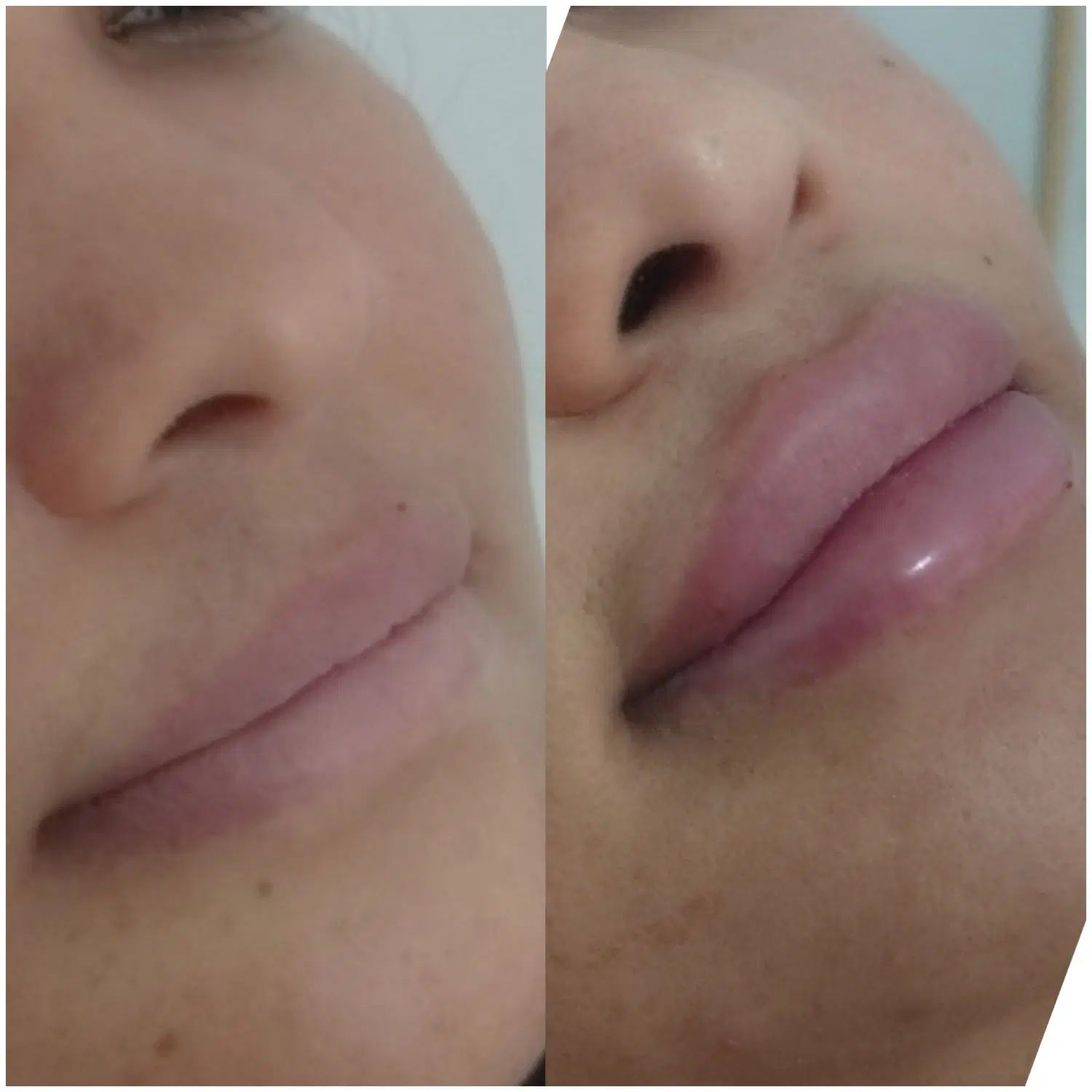 تزریق ژل و بوتاکس  و آموزش دارالرحمه شیراز|خدمات آرایشگری و زیبایی|شیراز, دارالرحمه|دیوار