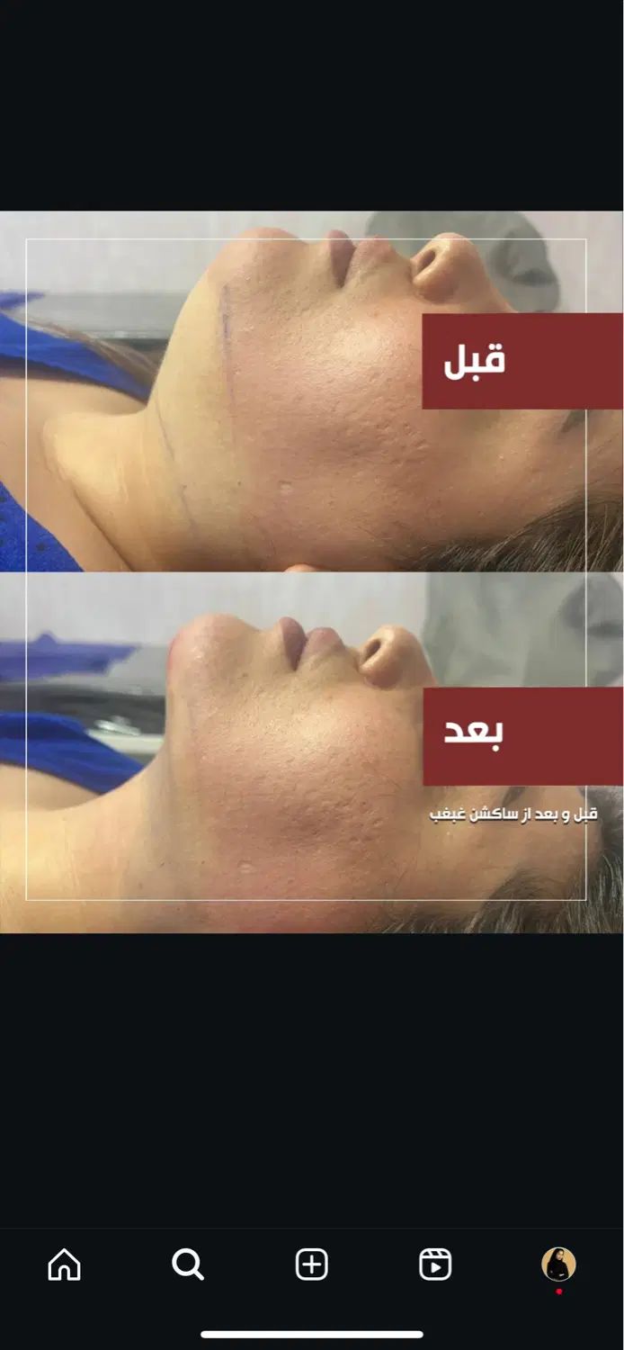 ساکشن غبغب ۳/۵۰۰تومن|خدمات آرایشگری و زیبایی|مشهد, فرهنگ|دیوار