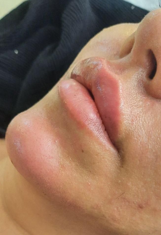 ژل و بوتاکس با قیمت باورنکردنی ترمیم رایگان|خدمات آرایشگری و زیبایی|کاشان, درب اصفهان|دیوار