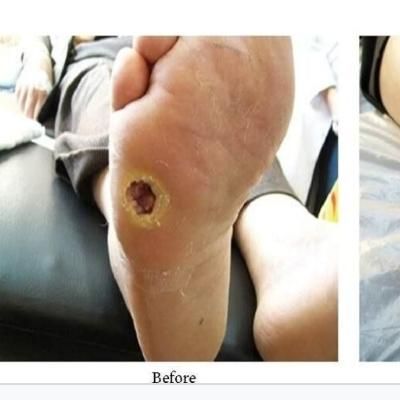 تزریقات سرم سوند پانسمان زخم بستر پای دیابتی|خدمات آرایشگری و زیبایی|تبریز, |دیوار