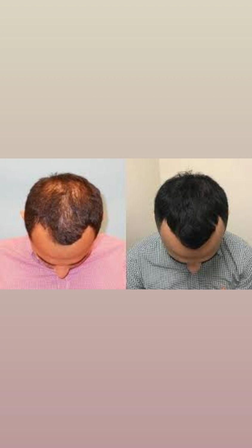 پی آر پی مو و صورت  فقط ۱۱۰۰|خدمات آرایشگری و زیبایی|محمدیه-قزوین, |دیوار