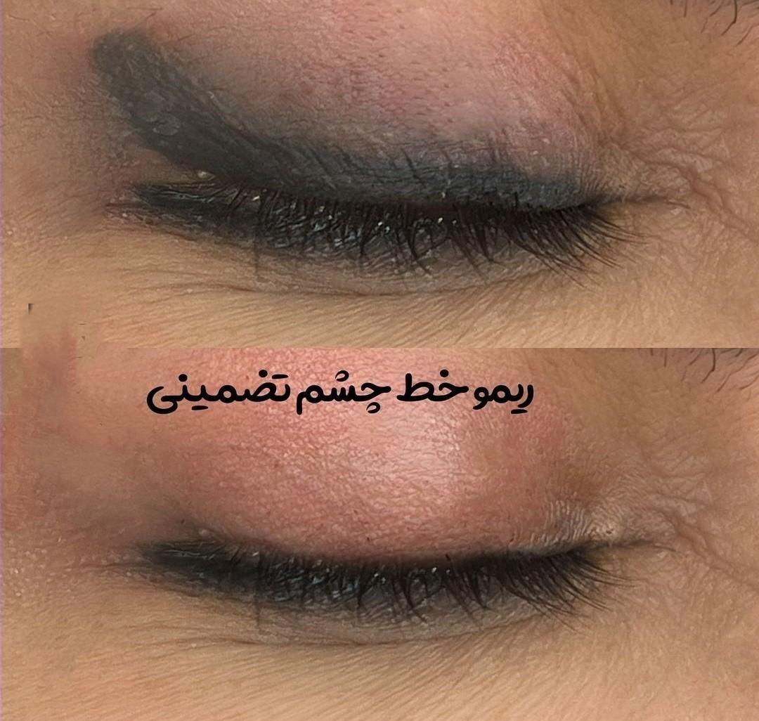 ریموو تخصصی تتو با مواد گیاهی اروپا تک جلسه|خدمات آرایشگری و زیبایی|تهران, دهکده المپیک|دیوار
