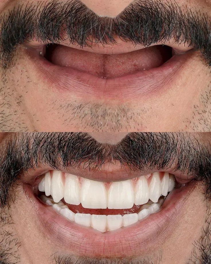 ایمپلنت فقط با پیش پرداخت 5990|خدمات آرایشگری و زیبایی|تهران, هروی|دیوار