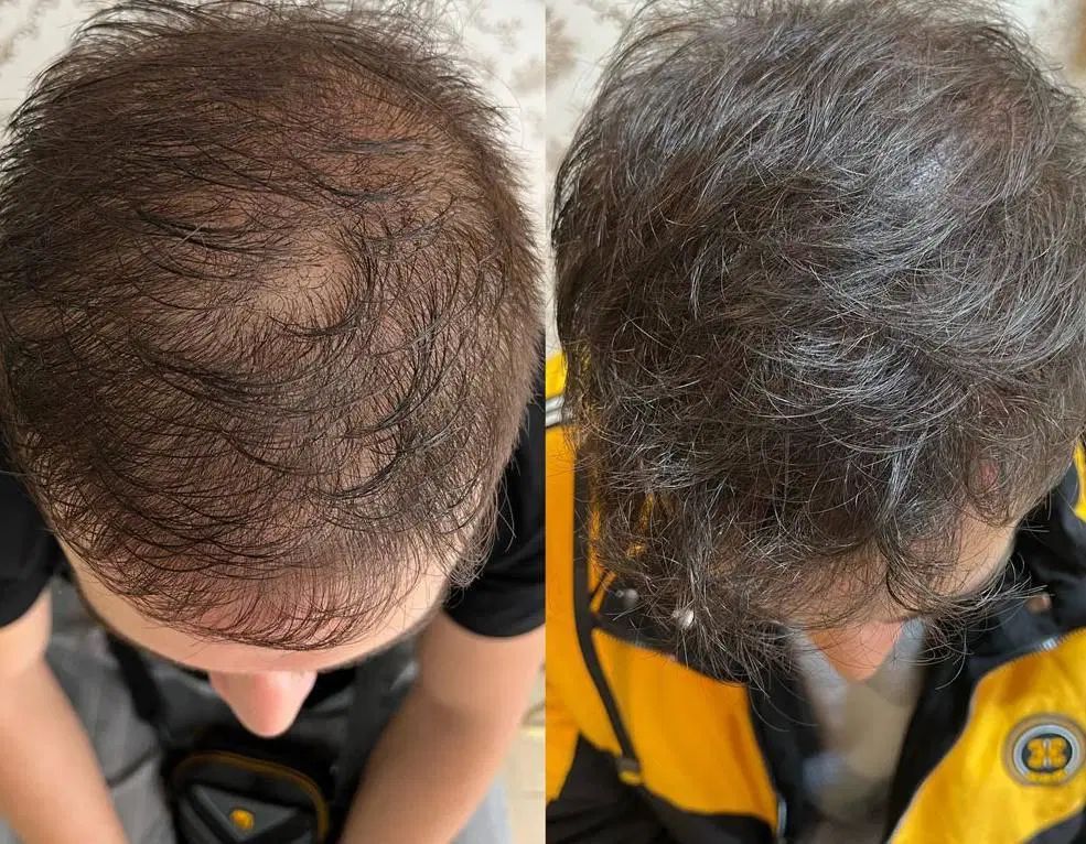 آموزش و خدمات میکرواسکالپ مکمل کاشت مو|خدمات آرایشگری و زیبایی|رشت, بوسار|دیوار