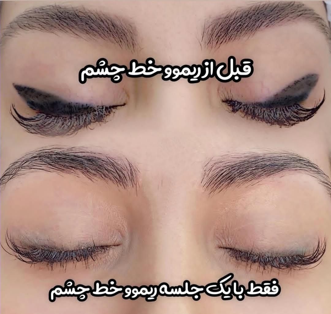 ریموو تخصصی تتو با مواد گیاهی اروپا تک جلسه|خدمات آرایشگری و زیبایی|تهران, دهکده المپیک|دیوار